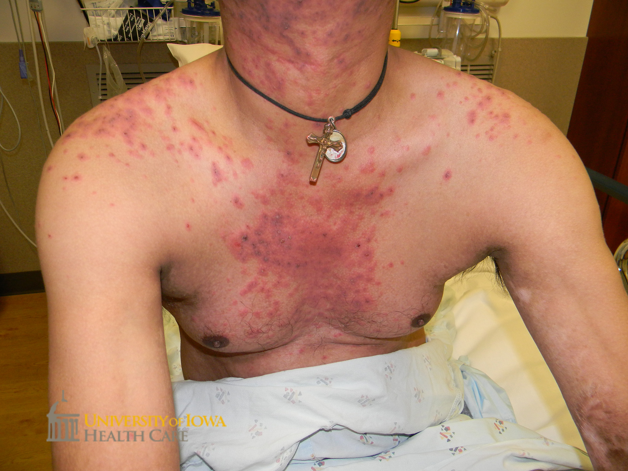 Atypical targetoid papules coalescing into plaques, some with with central purpura, on the trunk and extremities. (click images for higher resolution).